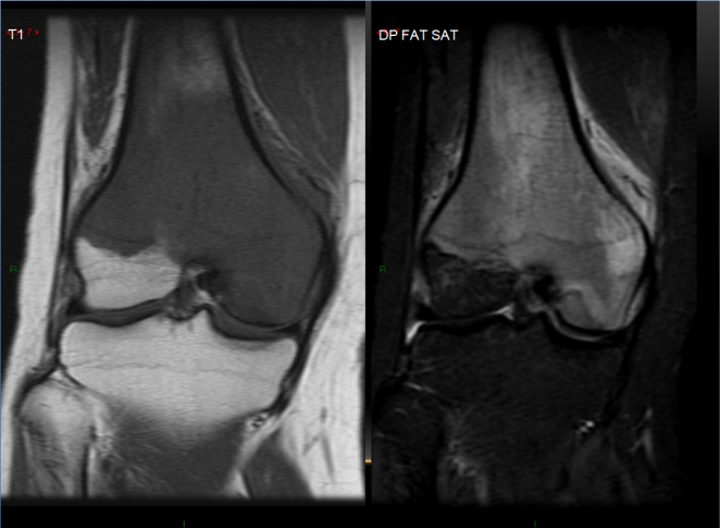 Secuencia CORONAL T1- dp fat sat