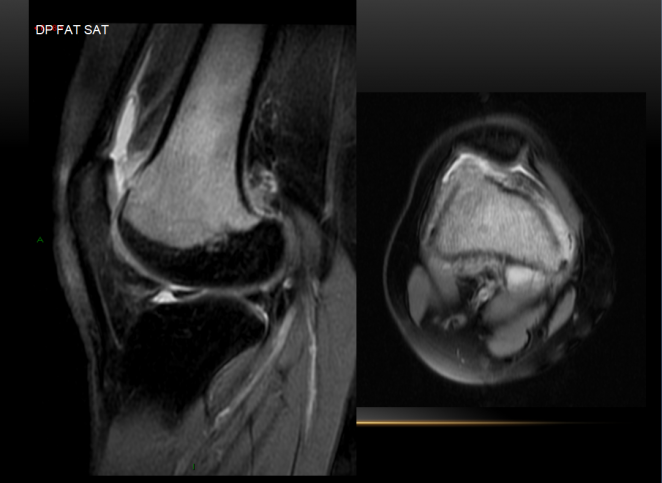 Sagital y axial DP fat sat
