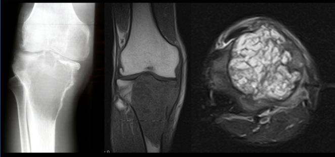 M&aacute;s frecuentes en mujeres de 20-50 a&ntilde;os. RX: en extremidad proximal de la tibia (METAFISOEPIFIARIA) lesi&oacute;n l&iacute;tica pseudotrabeculada de bordes definidos no esclerosados, la misma imagen en RM T1 lesi&oacute;n hipo intensa homog&eacute;nea y axial DP FAT SAT  hiperintens