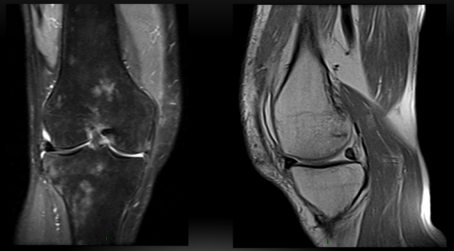 EDEMA &Oacute;SEO QUE SE DA POR AFECTACI&Oacute;N NERVIOSA sagital DP fat sat cirugia de minisco
