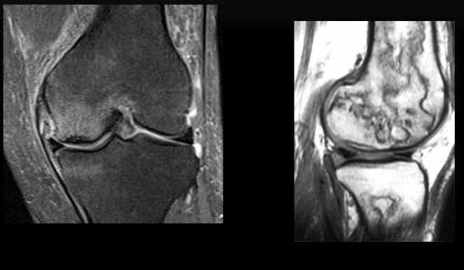 Reducci&oacute;n o falta de aporte sangu&iacute;neo. Osteonecrosis es subcondral. Infarto &oacute;seo afectaci&oacute;n epifisaria-metafisodiafisaria un patro serpiginoso de bordes hipointensos en T1. Causa multifactorial: idiopatica, traumatica, ingesta de corticoides. 