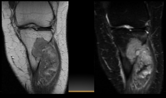 Tumor de formaci&oacute;n de matriz condroide, m&aacute;s frecuente en hombres, despu&eacute;s de los 40 a&ntilde;os. Lesi&oacute;n intramedular  de aspecto multinodulada que se extiende a partes blanda. T1: hipo DP FAT SAT hiper.