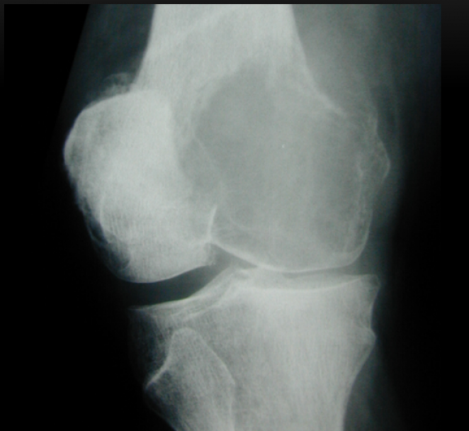 Incidencia anteroposterior lesi&oacute;n litica epifisaria. Com&uacute;nmente afecta el hueso medular del esqueleto axial en la zona metafisiodiafisiaria, siendo frecuentes los patrones osteol&iacute;ticos, osteobl&aacute;sticos y mixtos. Generalmente se presentan sin reacci&oacute;n peri&oacute;
